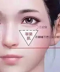 "自体脂肪丰苹果肌-杭州艺星整形美容医院"