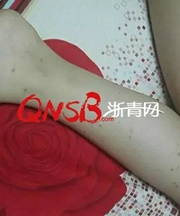 "义蓬一小多名学生流鼻血、起皮疹…… 家长"