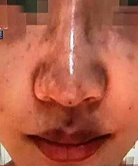 一天七针玻尿酸 她嘴唇都紫了