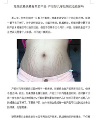 "大腿外侧有妊娠纹怎么办?产后擦什么去妊娠纹?"