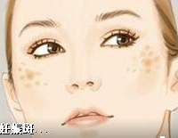 "除妊娠斑的方法—杭州艺星整形美容医院"
