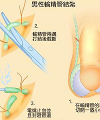 "产后避孕,上环和结扎,到底选哪个?"