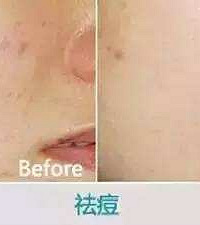 "光子嫩肤祛痘印—杭州艺星整形美容医院"