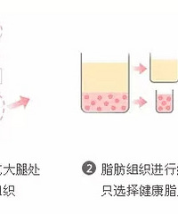 "自体脂肪丰胸,减肥塑形一举两得 -杭州艺星整形医院"