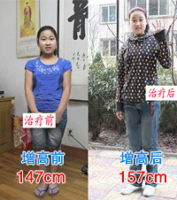 "成年人矮小能增高么?成都普济增高医院好不好?"