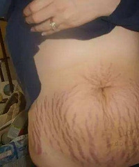 "妊娠纹是什么样的?妊娠纹的诊断标准是什么?怎么预防和淡化妊娠纹