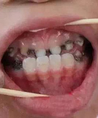 "乳牙不补:躲得了初一,躲不过十五"