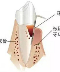 "洗牙vs龈下刮治,到底啥区别?"