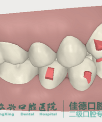 "地包天怎么治疗?| 肥西众兴口腔医生告诉你"