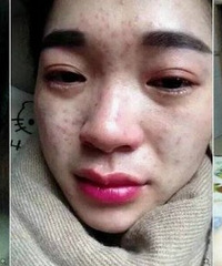 "哪些祛痘小窍门能学以致用?分享快速战痘秘诀"