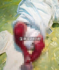 "浙江一女婴患罕见怪病 下肢皮肤缺失可见血管"