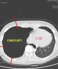 "凶险!15岁小姑娘突发胸闷气闭无法平卧"