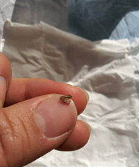 萧山第一人民医院妇科手术后残留物