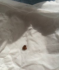 萧山第一人民医院妇科手术后残留物