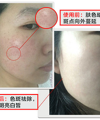 "哪个年龄阶段能避免长斑?产后祛斑方法用什么好"