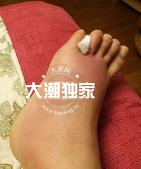 "吓人!海宁一女子泡脚出事了!曾有人因此截肢"