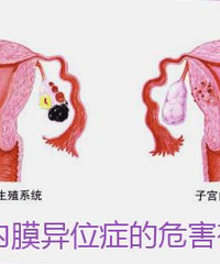 "患子宫内膜异位有哪些危害"