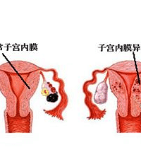 "子宫内膜异位症状有哪些"