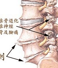 "诱发骨质增生的原因有哪些,如何预防?"