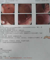 胃里有息肉