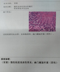 胃里有息肉