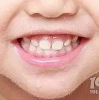 "2岁宝宝蛀牙怎么办?如何给宝宝护理牙齿?"