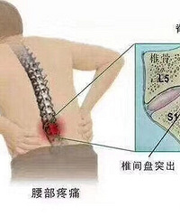 "为什么腰间盘突出会导致腿疼?"