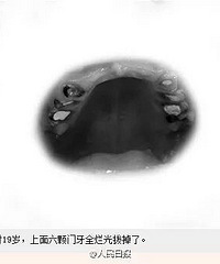 "19岁女孩一口牙齿“溶解”了…这个饮食习惯,孩子尤其要戒"