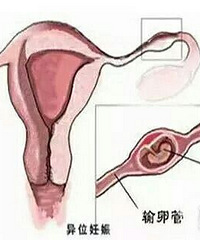 "浙江37岁女子怀孕,一查子宫是空的!医生竟通过肚脐取出..."