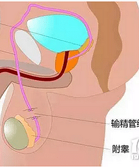 "夫妻双方没有生育需求的情况下 你支持男性结扎吗?"