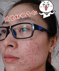 "易爆痘体质如何保养?分享祛痘秘方"