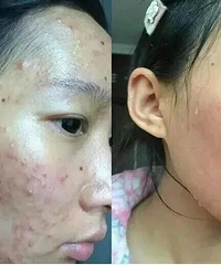 "改变你女神的外貌就是祛痘 哪些方法适合女生祛痘"