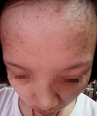 哪些祛痘面膜效果好?额头痘痘怎么去掉?