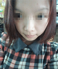 哪些祛痘面膜效果好?额头痘痘怎么去掉?