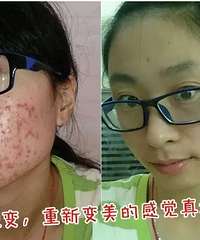 什么原因能保发这么多痘痘,诱因都在你家里