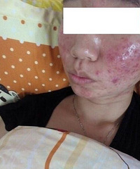 "痘痘痘印淡化之后,我却要疯了"