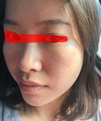 "痘痘好转真的很开心,分享多年来祛痘经历"