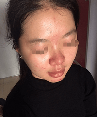 "怎么祛痘改善肤质?痘痘肌的福利要收好"