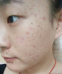 "哪些方法祛痘不影响皮肤?内调祛痘方法好不好"