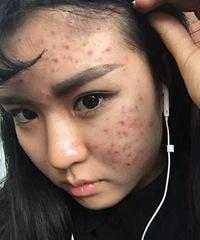 "脸上发红长痘怎么去掉不会变成红血丝?"