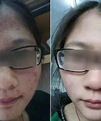 "青春痘过多怎么缓解?哪个牌子的祛痘膏适合?"