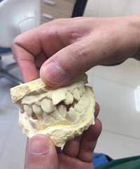 粗心的妈妈在儿子换牙期间没注意 现在儿子变成了牙套弟弟……