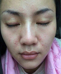 "她是如何成功祛痘的?怎么知道自己是什么痘痘"