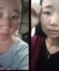 "巧妙运用祛痘方法,肌肤也变得细腻润滑"