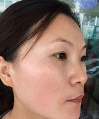 "黄褐斑有什么办法去除 佰肌净祛斑会反弹吗"
