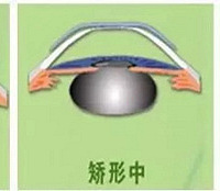 "近视了怎么办?艾格眼科专家告诉你改善近视有这几种方式"
