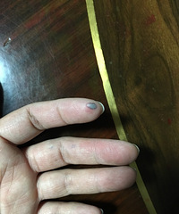 手指指腹被夹出紫黑色的肿块,能自己恢复吗?