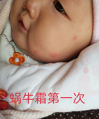 宝宝被蚊子咬了怎么办?
