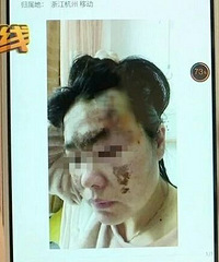 女子在萧山坐滴滴遇车祸,留下8公分的疤!谁来赔?