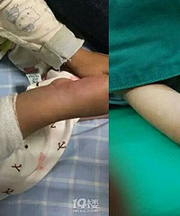 4岁女孩手臂莫名长出一圈肉环,差点截肢
